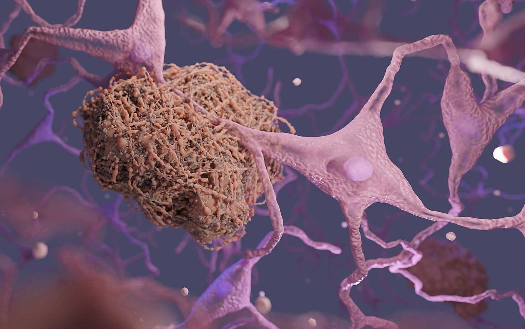 Amyloids on a brain cell